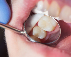 closeup shot of teeth being examined by a dentist