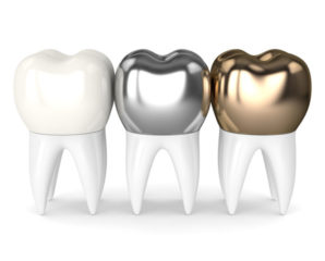 Ceramic and metal dental crowns