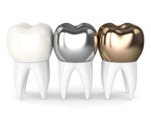 Ceramic and metal dental crowns